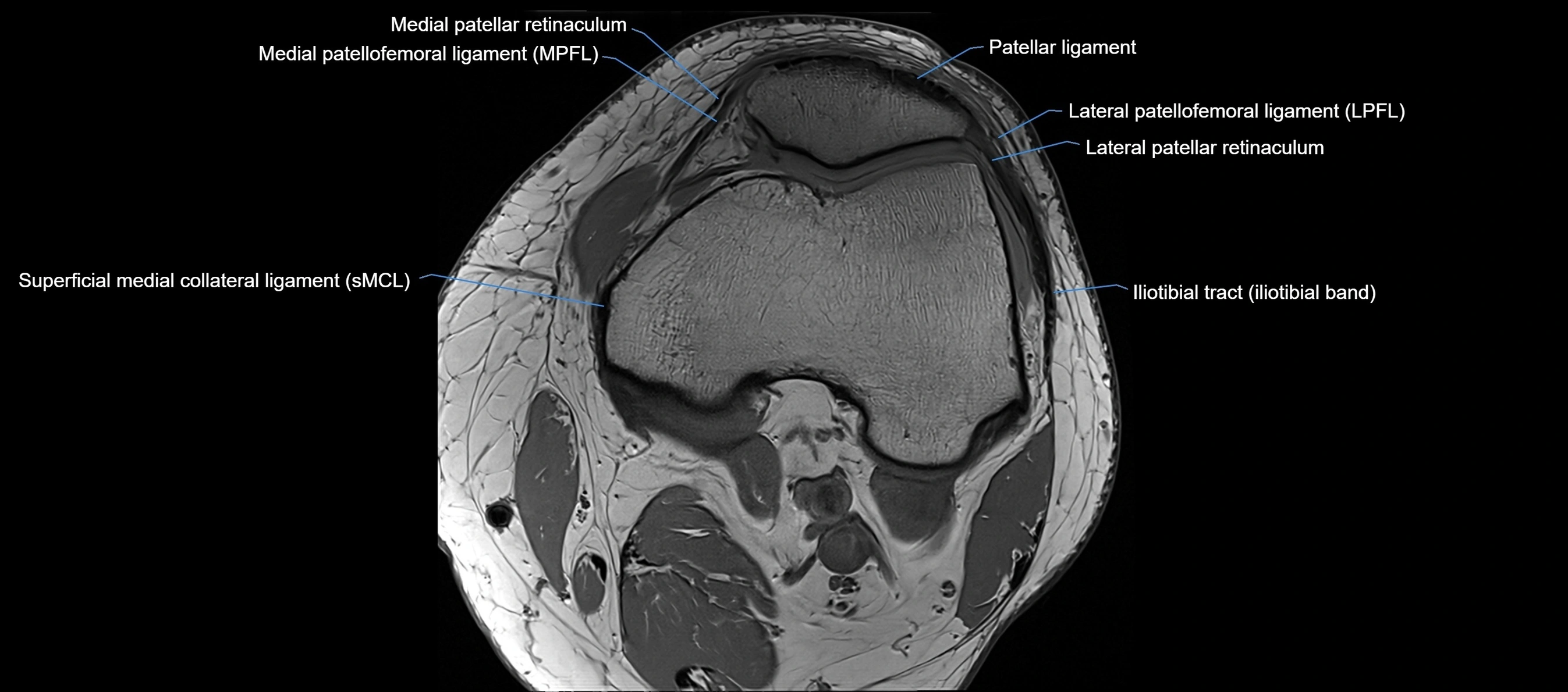 MRI Knee axial  ligaments cross sectional anatomy 3T  radiology  image-img-03001-00016.webp